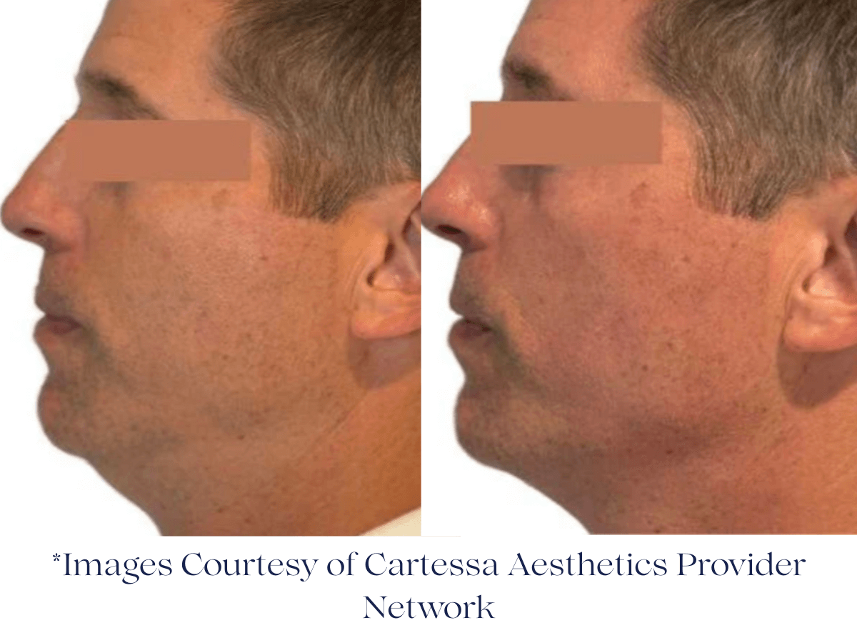 Before and immediately after Everesse RF -Image Courtesy of Cartessa Provider Network Before and immediately after Everesse RF -Image Courtesy of Cartessa Provider Network