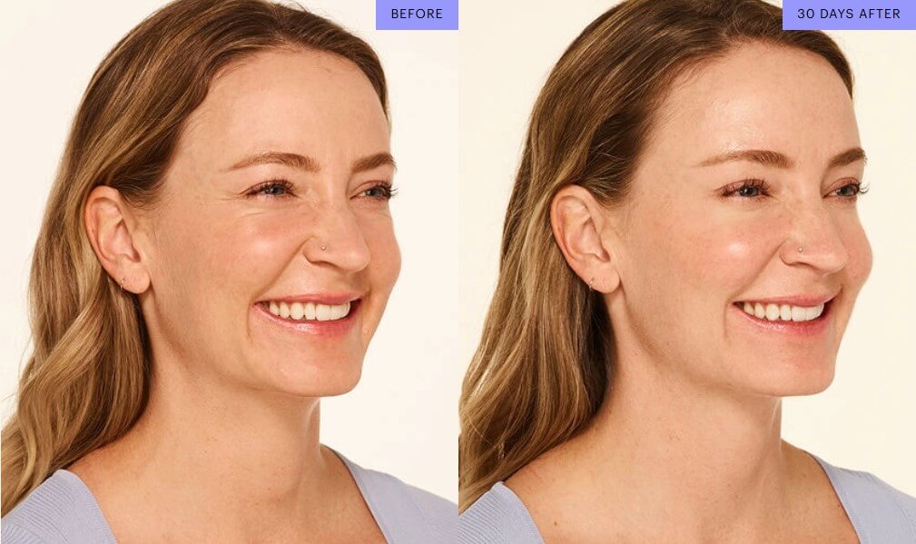 Before and After Botox Injections in Savannah, GA
