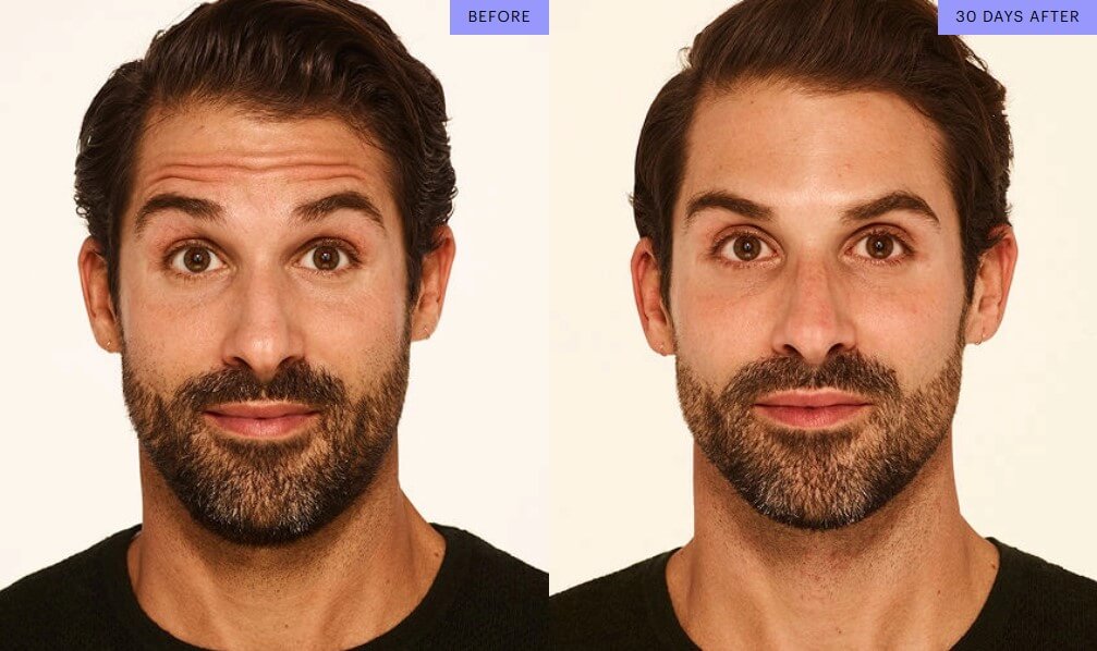 Forehead lines before and after Botox Treatment