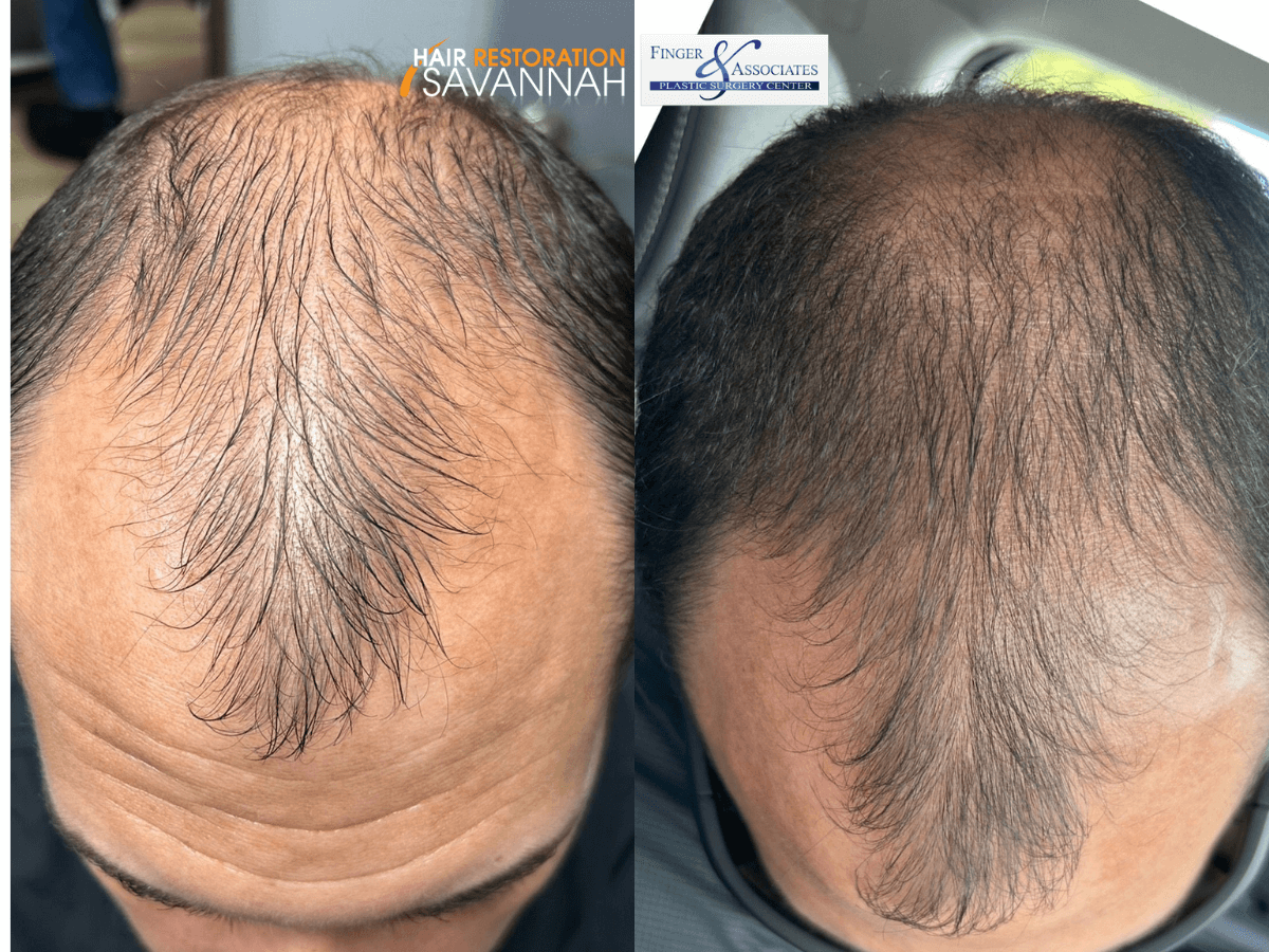 Before and after 11 days of receiving one DERIVE hair growth treatment Before and after 11 days of receiving one DE|RIVE hair growth treatment