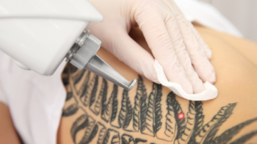 Chrome Lase Station at Finger and Associates