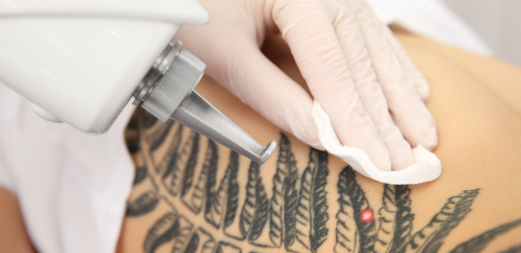 Chrome Lase Station at Finger and Associates