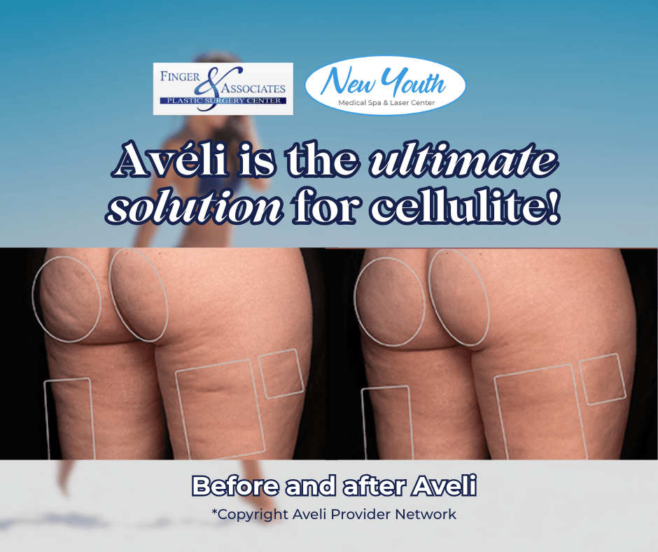 Before and After Aveli at Finger and Associates Before and After Aveli at Finger and Associates