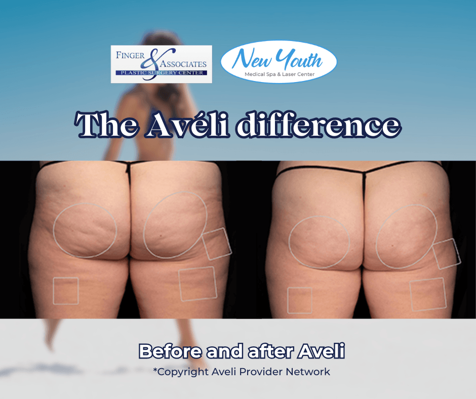 Before and After Aveli at Finger and Associates Before and After Aveli at Finger and Associates