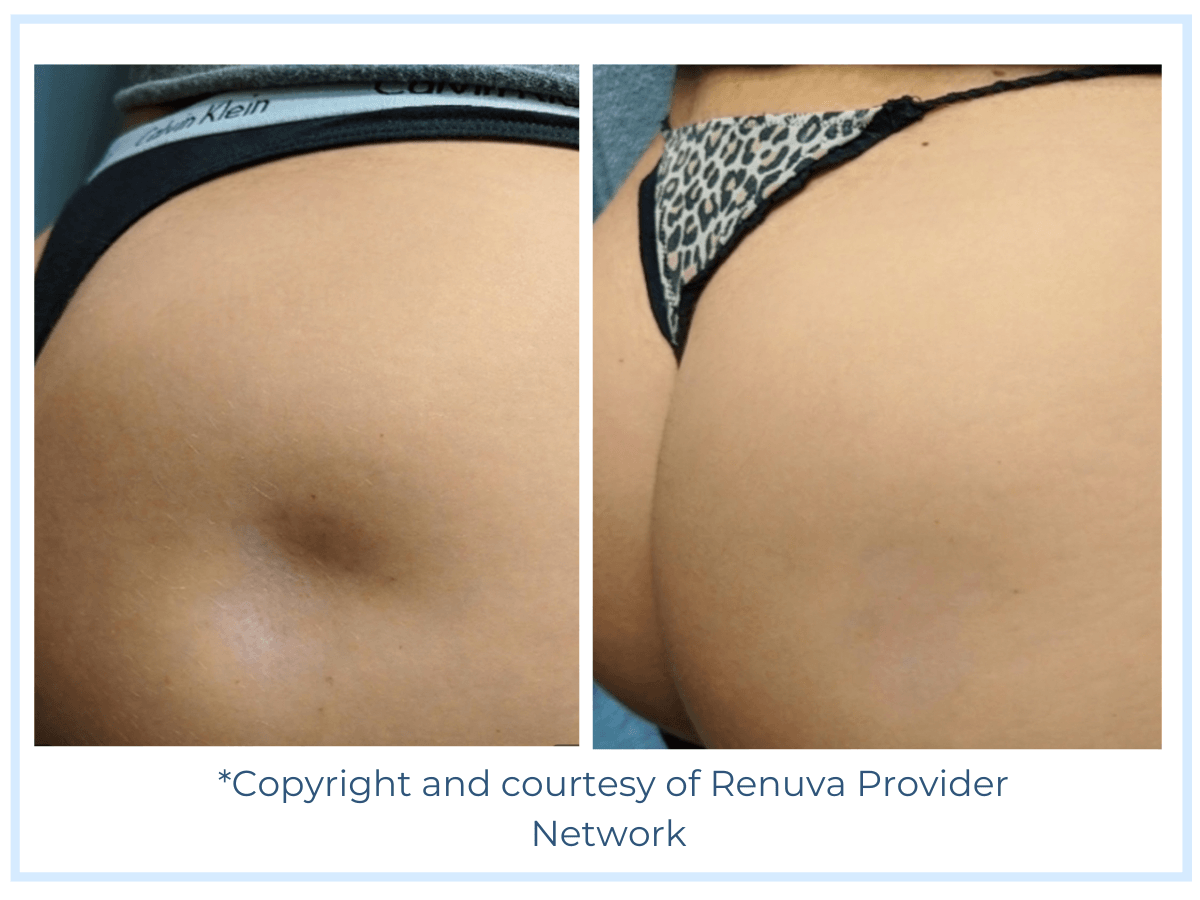 Cellulite Treatment with Renuva at Finger and Associates in Savannah, GA Cellulite Treatment with Renuva at Finger and Associates in Savannah, GA