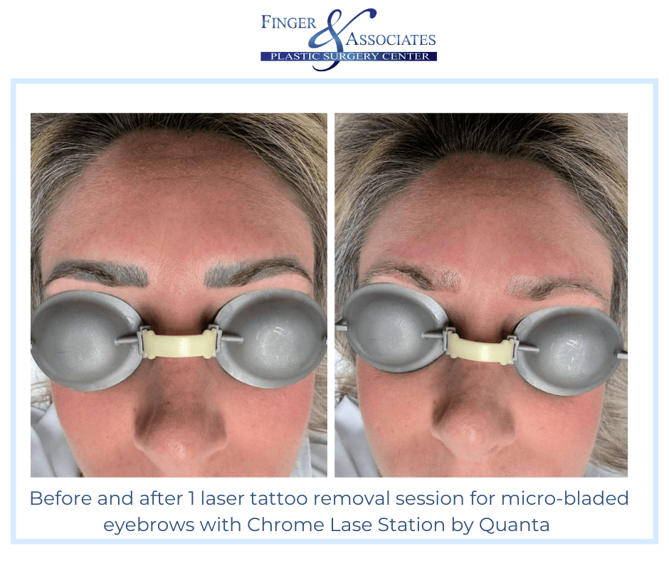 Before and after 1 laser tattoo removal session with Chrome Lase Station at Finger and Associates In Savannah, GA