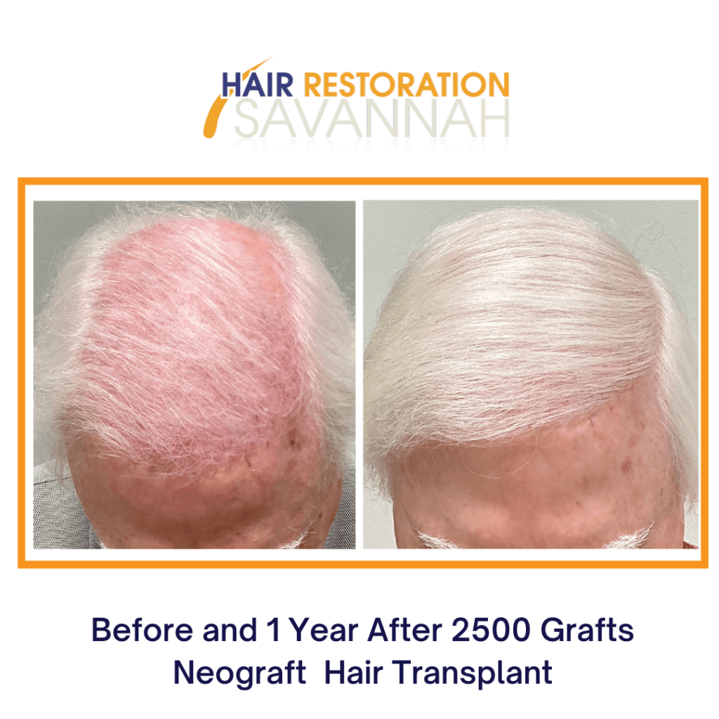 Before and 1 Year After 2500 Grafts Neograft Hair Transplant