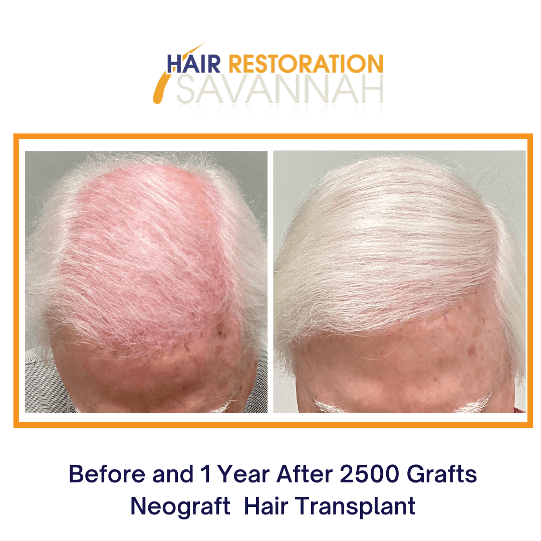 Before and 1 Year After 2500 Grafts Neograft Hair Transplant