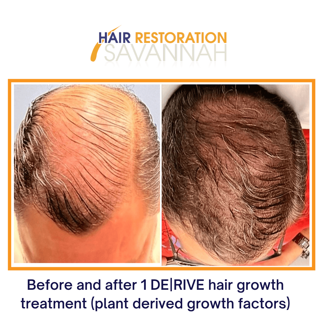 Before and after 1 DE|RIVE hair growth treatment (plant derived growth factors) Before and after 1 DE|RIVE hair growth treatment (plant derived growth factors)