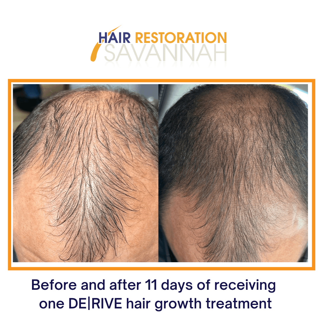 Before and after 11 days of receiving one DE|RIVE hair growth treatment Before and after 11 days of receiving one DE|RIVE hair growth treatment