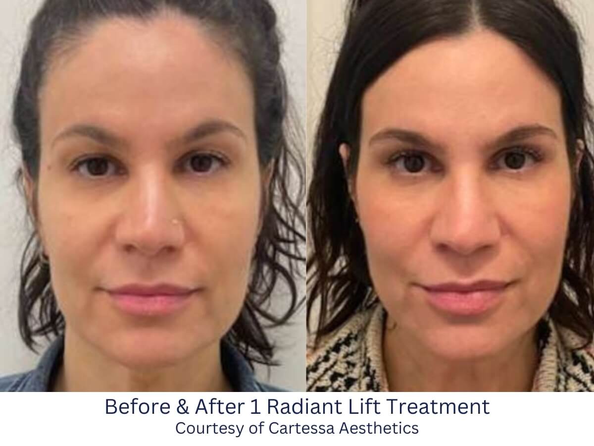 Before and After 1 rained Lift Treatment in Savannah, GA Before and After 1 rained Lift Treatment in Savannah, GA