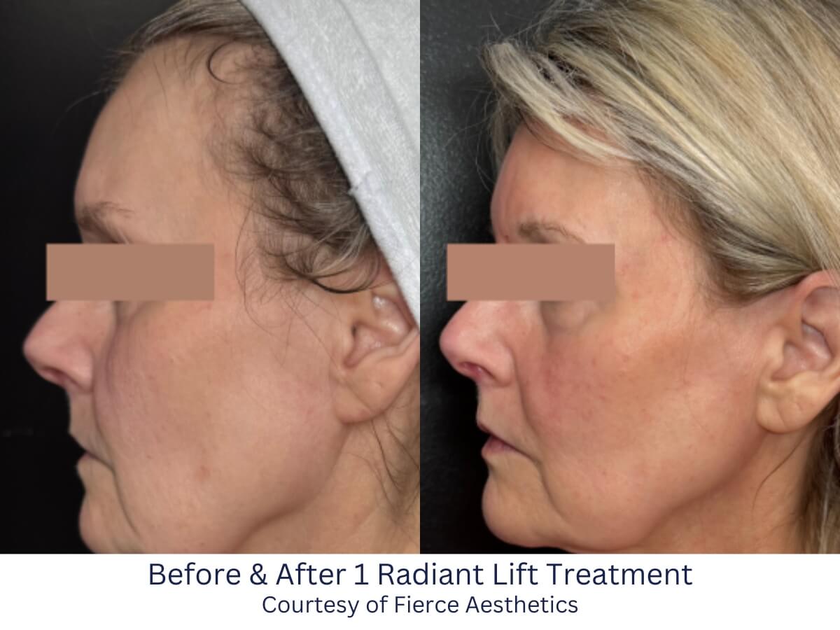 Before and After 1 rained Lift Treatment in Savannah, GA Before and After 1 rained Lift Treatment in Savannah, GA